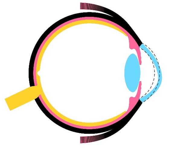 Grafik Keratokonus