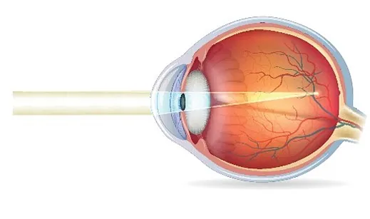 Kurzsichtiges Auge